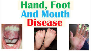 Hand Foot Mouth Disease in AP