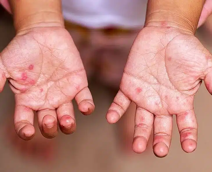 Hand Foot Mouth Disease in AP