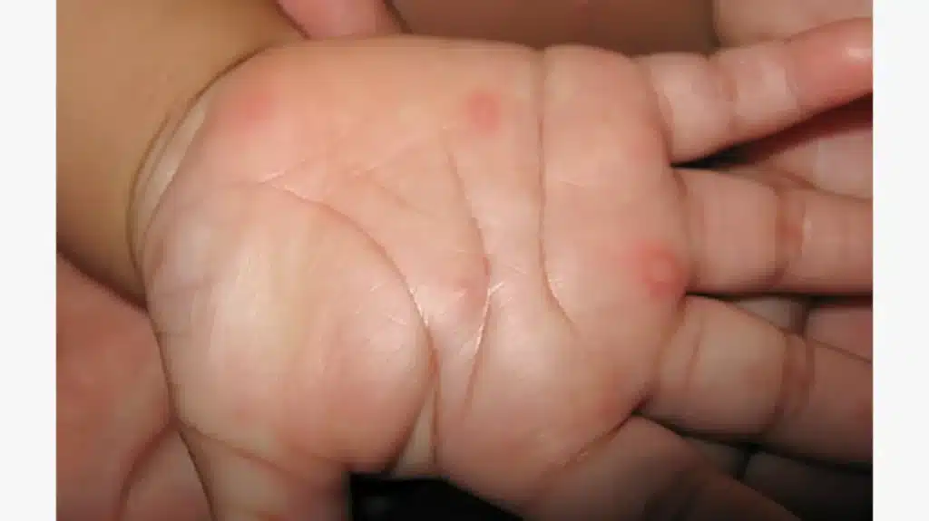 Hand Foot Mouth Disease in AP