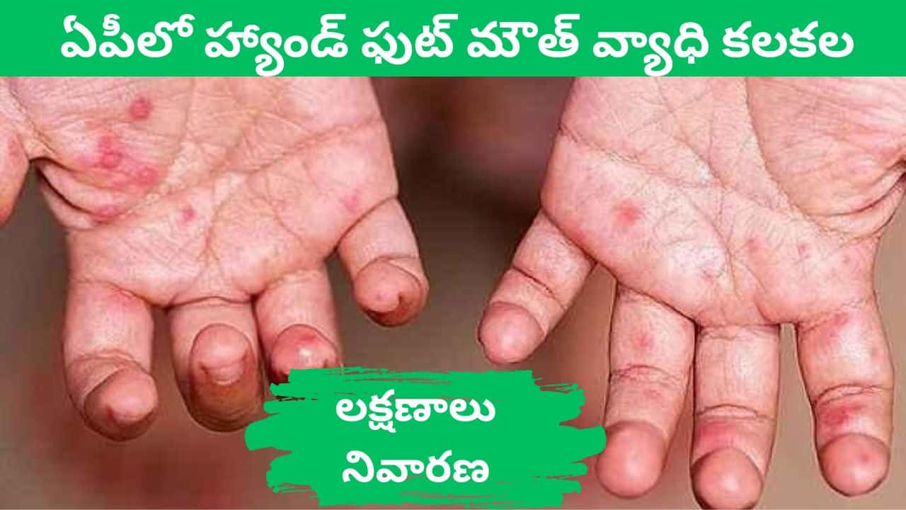 Hand Foot Mouth Disease in AP